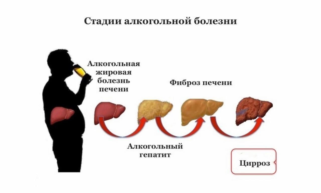 Стадии болезни